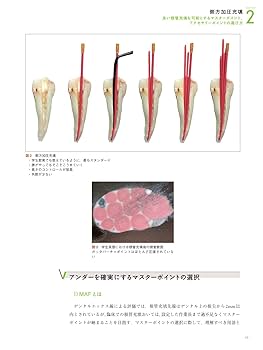 根管充填 | 吉岡 隆知, 吉岡 俊彦, 八幡 祥生, 橋本 健太郎, 興